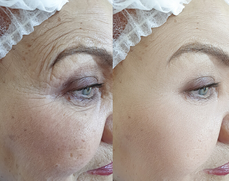 Plastyka powiek_Operacje powiek górnych_Operacje powiek dolnych_Korekcja powiek_Blepharoplastyk